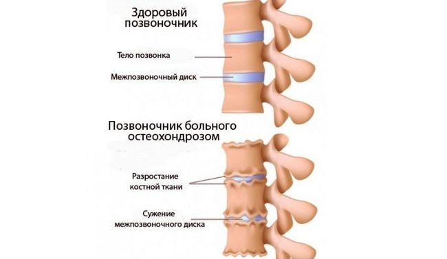 Здоровый позвоночник и больного остеохондрозом