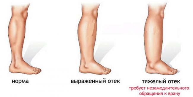 Отек может быть разной степени. При тяжелых следует незамедлительно обращаться к врачу 