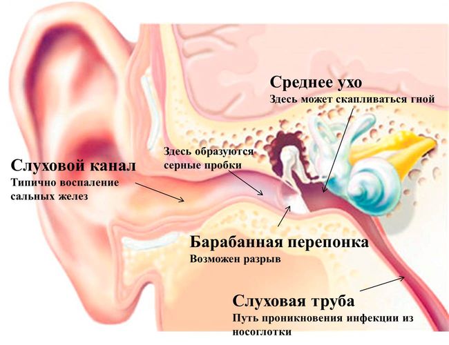 Воспаление уха грозит тяжелыми последствиями для человека