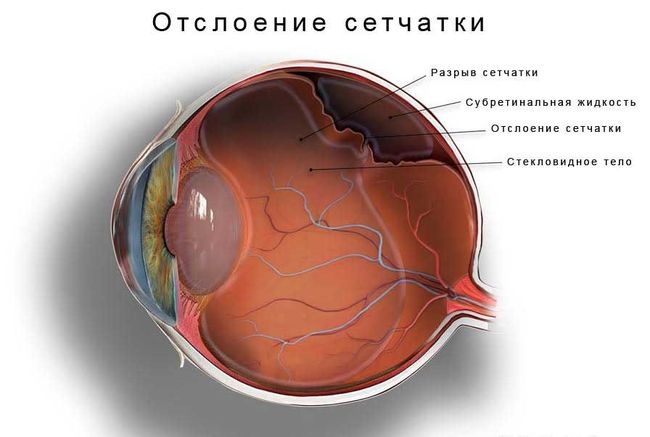 Отслоение сетчатки глаза происходит в большинстве случаев у людей пожилого возраста.