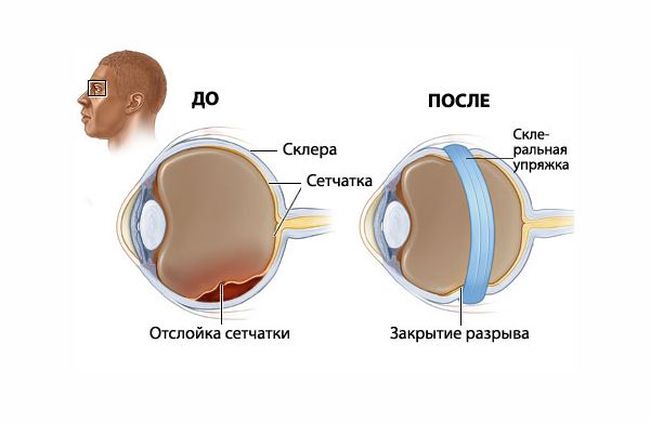 После лечения заболевания зрение будет восстановлено.