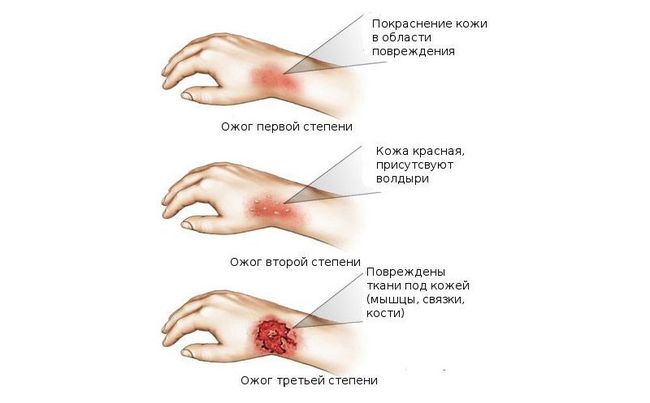 Степени ожога кипятком