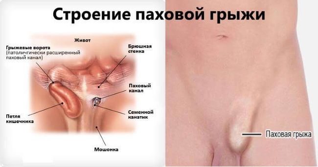 При паховой грыже стенки брюшной полости не могут удерживать внутренние органы на своих местах