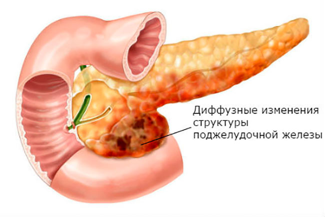 Диффузные изменения в паренхиме поджелудочной железы, обычно говорят о замещении железистой ткани рубцами или жировыми клетками