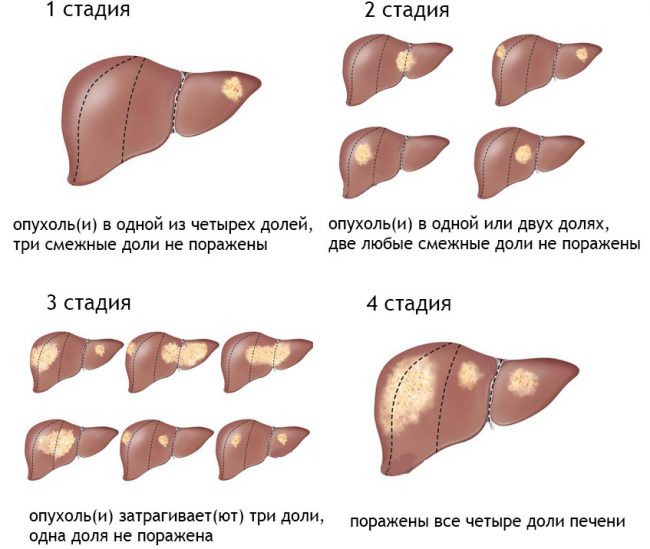 Рак печени – тяжелейшая онкологическая патология, которая может унести жизнь пациента за считанные месяцы.
