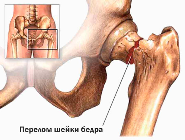 Перелом шейки бедра в пожилом возрасте – это очень серьезная проблема, так как реабилитационный период у людей преклонного возраста затягивается, и зачастую наступает инвалидность