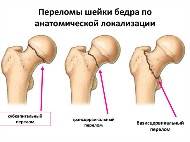 Перелом шейки бедра со смещением характеризуются острой болью и деформацией кости, такой перелом опасен кровоизлиянием в мягкие ткани бедра