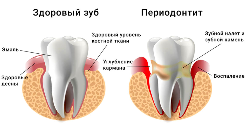 Периодонтит - воспаление тканей, расположенных вокруг корня зуба