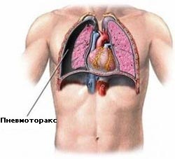 Пневмоторакс фото