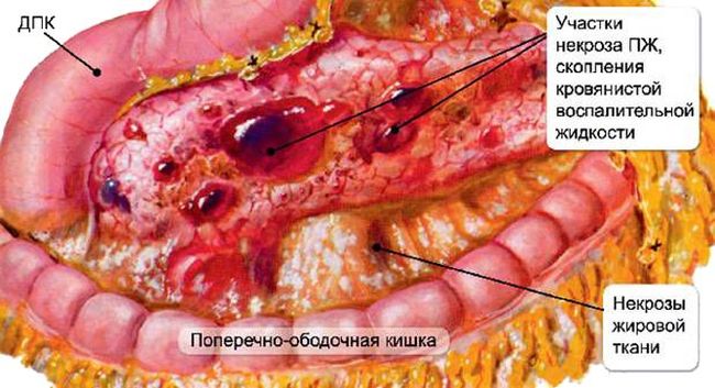 Хронический панкреатит - это хроническая форма воспаления поджелудочной железы