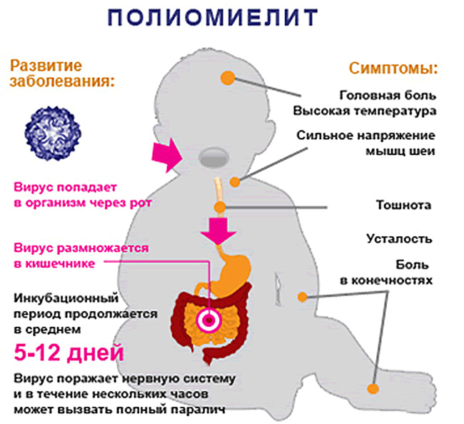 Полиомиелит поражает, в основном, детей до пяти лет, для взрослых в большинстве случаев не опасен