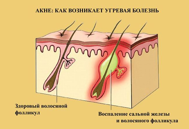 Возникновение угревой болезни