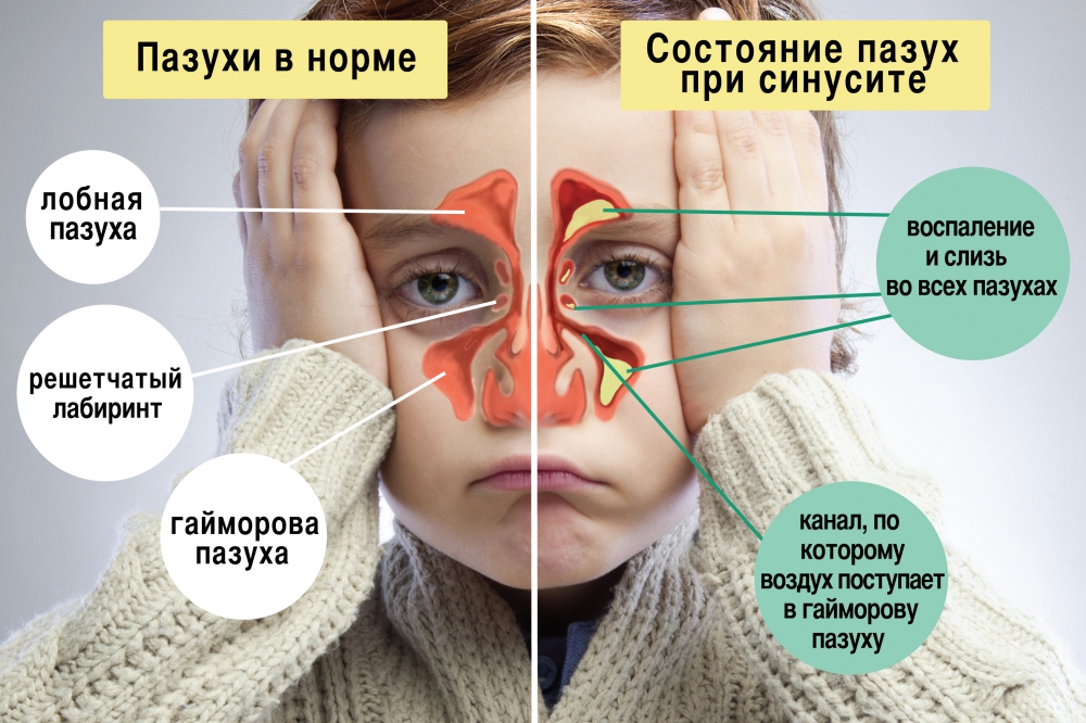 На фото показано состояние носовых пазух в норме и при синусите.