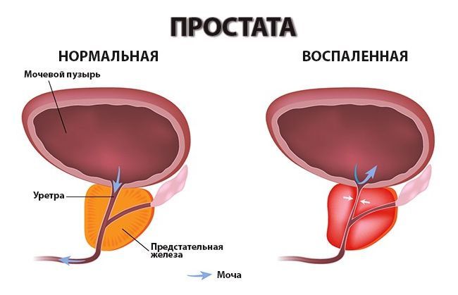 Простатит у мужчин может наступить из-за малоподвижного образа жизни.