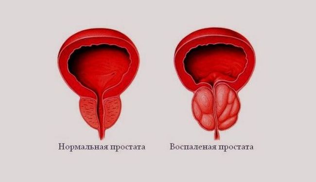 На фото показана нормальная и воспаленная простата.