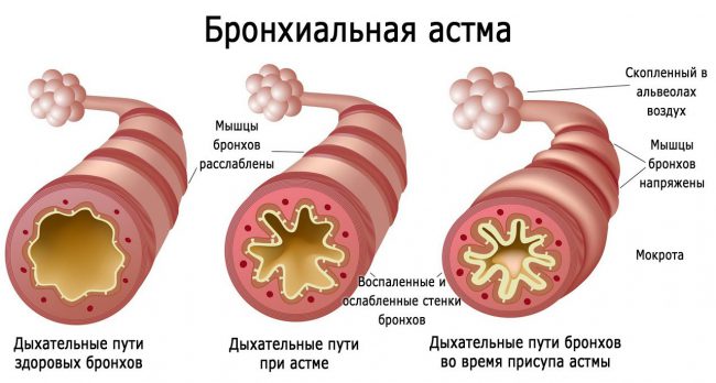 Препарат используют для профилактики обострений в течение бронхиальной астмы, применение при острых приступах нецелесообразно