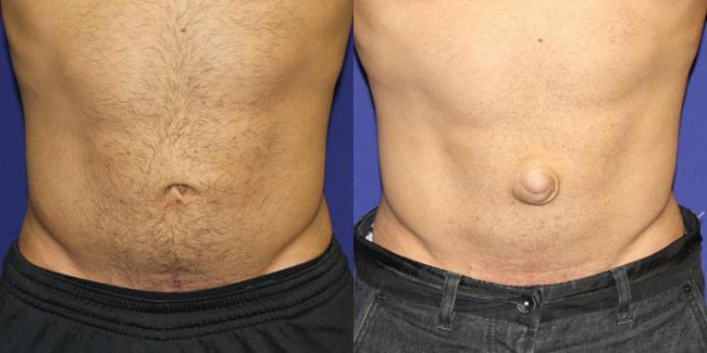 Живот, слева - норма, справа - пупочная грыжа