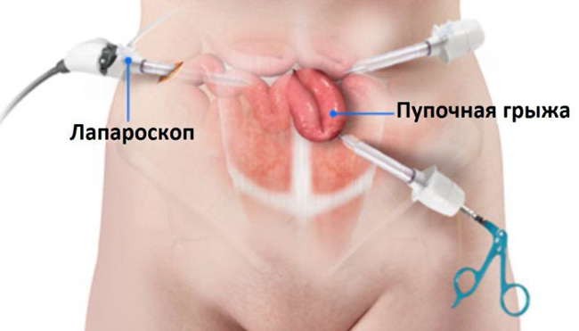 Лапороскопия, наименее травматичный способ хирургического вмешательства при пупочной грыже, благодаря этому, сводится к минимуму период реабилитации