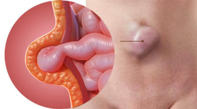 Пупочная грыжа – выпячивание внутренних органов через мышцы передней брюшной стенки. Такая грыжа локализуется вокруг пупка в «пупочном кольце»