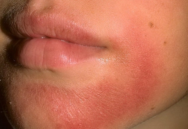 Радевит применяется для лечения дерматита различной этиологии