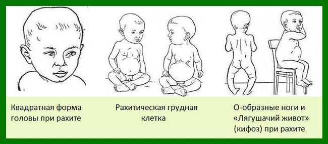 Признаки рахита у ребенка