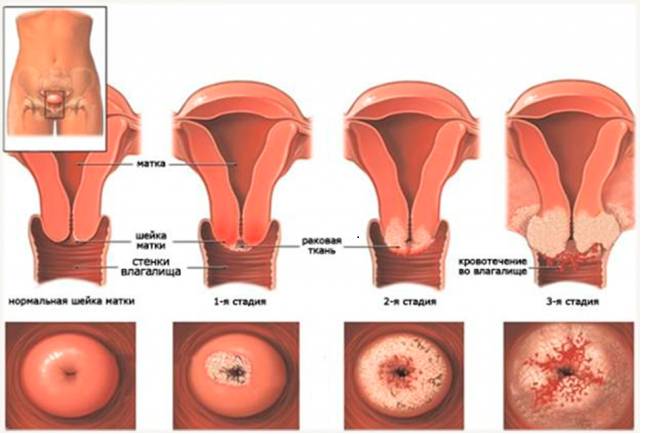 Рак шейки матки в инвазивной стадии, попадает в мембрану, затем проникает в параметрии. Со временем новообразование распространяется на стенки таза, затем переходит в прямую кишку или прорастает в мочевой пузырь