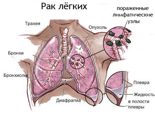 Как и любой другой вид рака, так и рак легких имеет несколько видов, которые отличаются разной степенью тяжести и скорости развития.