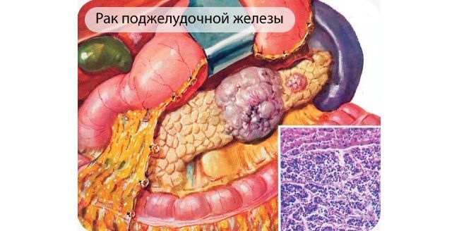 Рак поджелудочной железы занимает четвертое место в списке смертности от рака в США