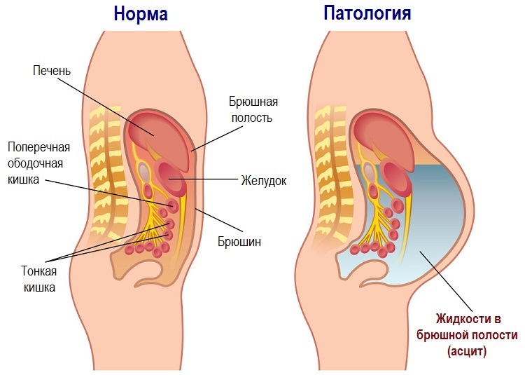 При раке яичников также возможен асцит (активное накопление жидкости в брюшной полости), что грозит дискомфортом и отдышкой.