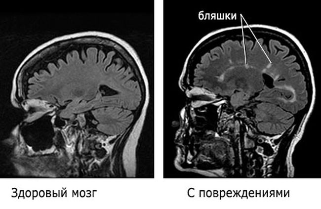 Первые признаки рассеянного склероза становятся заметны лишь тогда, когда иммунная система повредила коло 40 процентов нейронов