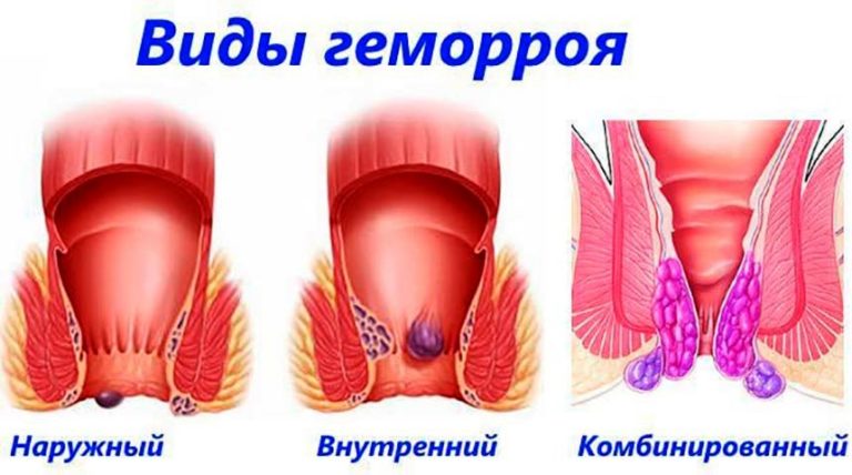 На фото показаны 3 вида геморроя и их различия: Наружный, Внутренний, Комбинированный геморрой.