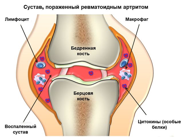 Ревматоидный артрит поражает суставы