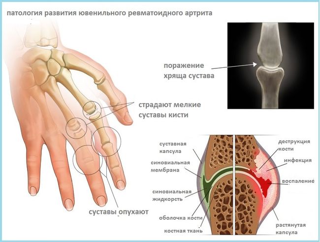 Патология развития ювенильного ревматоидного артрита у человека