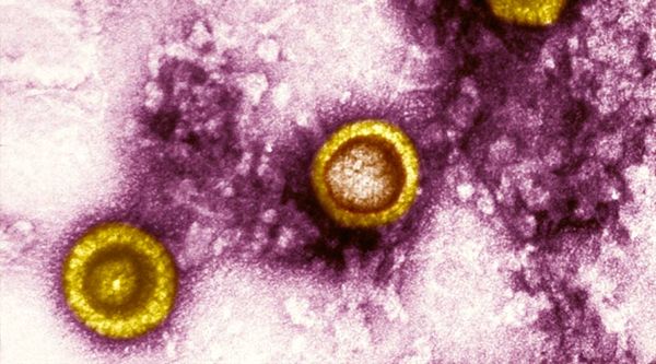 Саркома Капоши чаще проявляется у ВИЧ-инфицированных людей