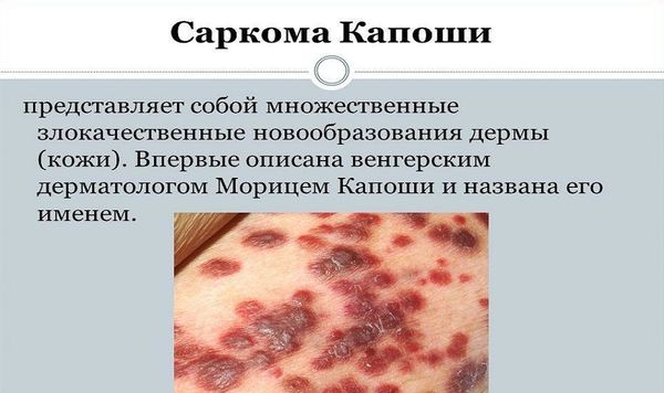 Проявление саркомы Капоши на теле