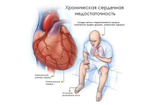 Сердечная недостаточность бывает острой и хронической