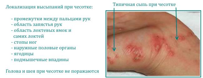 Для борьбы с чесоткой следует соблюдать ряд правил и постоянно использовать мазь не пропуская ни одного дня
