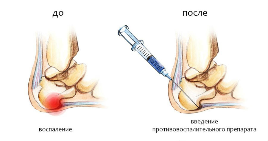 Блокада пяточной шпоры посредством введения лекарства в проблемную точку должен проводить опытный врач, иначе любая ошибка может привести к серьезным последствиям