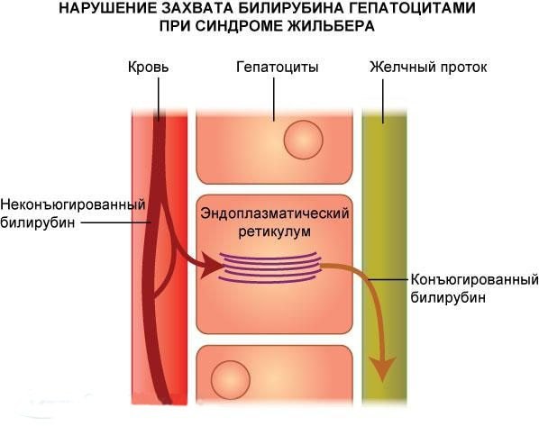 Из-за дефекта в одной из хромосом, организм банально не умеет правильно справляться с билирубином, в следствии чего начинается интоксикация организма.