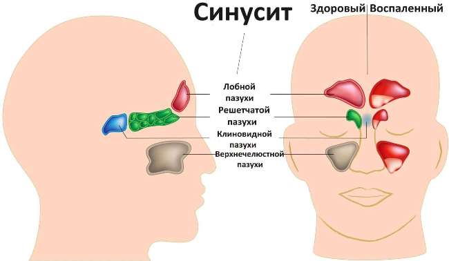Синусит - воспаление слизистой оболочки носовых пазух, сопровождается обильными выделениями из носа