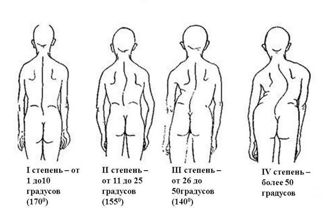 Сколиоз делится на несколько степеней, от 1-й до 4-й