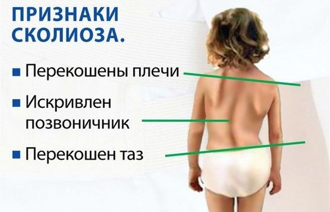 Искривленный позвоночник - один из главных признаков сколиоза