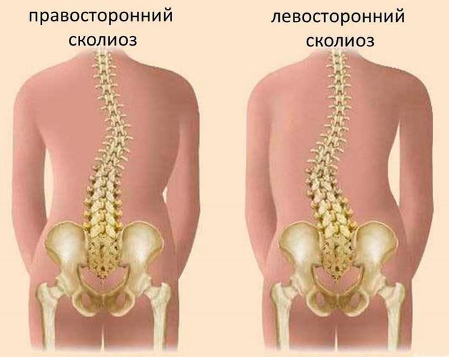 Правосторонний и левосторонний сколиоз 2 степени