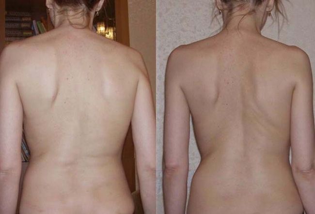 На фото показан сколиоз второй степени