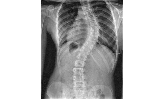 Сколиоз второй степени протекает бессимптомно
