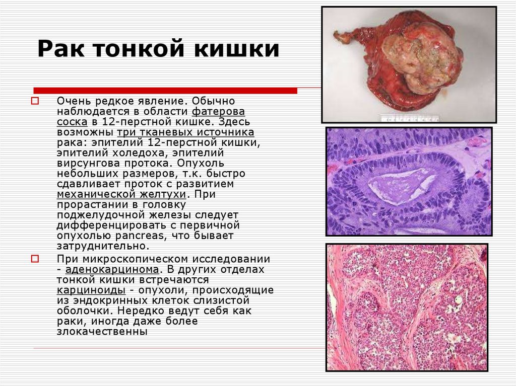 Рак тонкой кишки - внешний вид опухоли, вид под микроскопом.