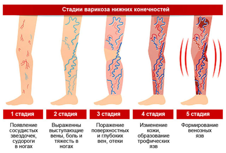 На фото показаны 5 стадий варикоза нижних конечностей. 1 стадия - появление сосудистых звездочек, судороги в ногах. 2 стадия - выражены выступающие вены, боль и тяжесть в ногах. 3 стадия - поражение поверхностных и глубоких вен. 4 стадия - изменение кожи, образование трофических язв. 5 стадия - формирование венозных язв.