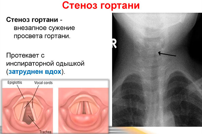 Стеноз гортани – это сужение просвета гортани, которое мешает поступлению воздуха и затрудняет дыхание на короткий промежуток времени