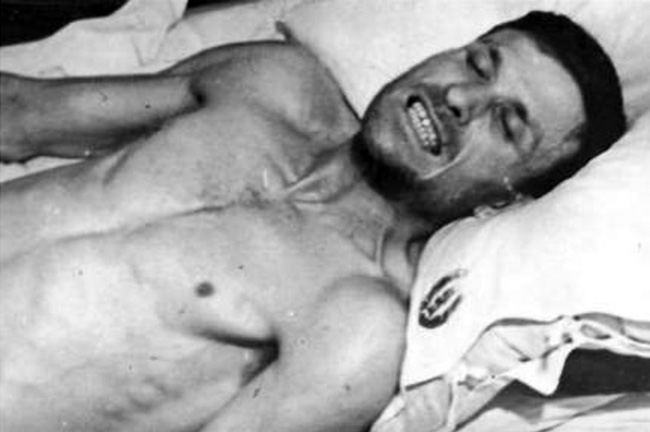 Начальный этап заболевания длиться 1-2 дня и проявляется в виде судорожного сжатия жевательных мышц, «Сардонической улыбкой», нарушения глотания