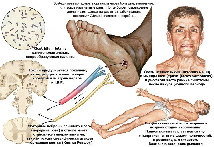 Пути проникновения и результаты деятельности возбудителя столбняка палочки Clostridium tetani